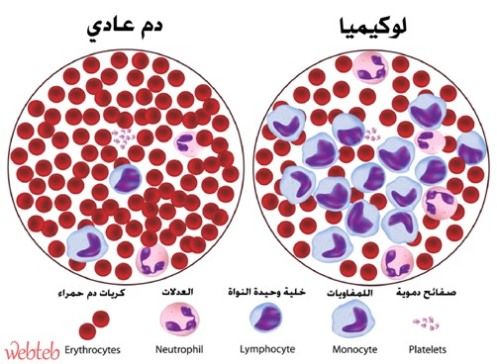 معلومات اول مرة تعرفها عن اعراض السرطان , عوارض سرطان الدم