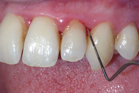 ماهو علاج التهاب اللثة - احسن علاج في المنزل لالتهاب اللثة Gingivoglossitis Def 3322 2