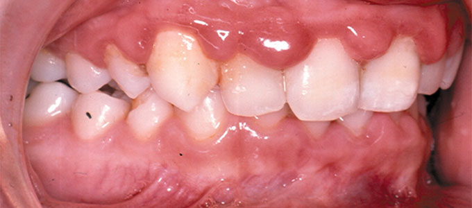 ورم اللثة - الاورام في اللثة توجع القلب Gingivitis In Children1