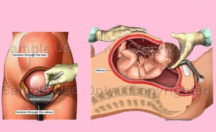 الولادة القيصرية بالصور لحظة بلحظة , تفاصيل لا تعرفها عن مخاطر تجربة الولادة القيصيرية