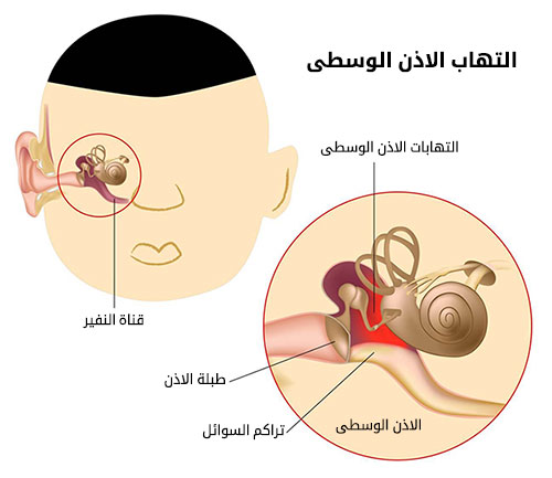 التهاب الاذن الوسطى , بالمتابعة لن تتعرض للالتهاب الاذن الداخلية الوسطي