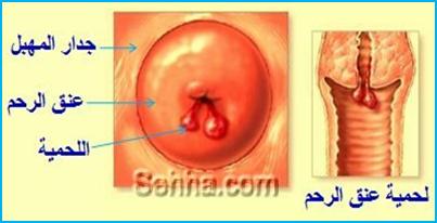 لحميات عنق الرحم , هل هذه الاعراض تعني انه يوجد لحمية في الرحم