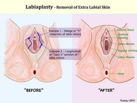 الجراحة التجميلية للمهبل , ودعي الاحراج من زوجك مع تجميل المهبل وتضييقه بجراحة بسيطة