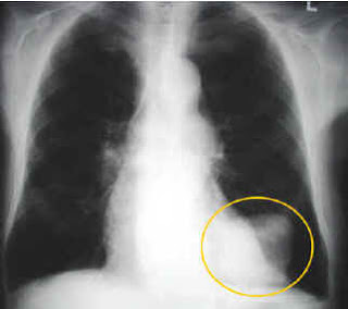 اعراض سرطان الرئة - علامات تدل على اصابتك بمرض كانسر الرئتين Lung Cancer