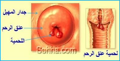 C4996D52Ceecbcd9659E2Db2F9Cb8Cf0 لحميات عنق الرحم - هل هذه الاعراض تعني انه يوجد لحمية في الرحم تميمة حسام