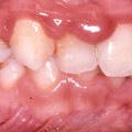 Gingivitis In Children1 ورم اللثة - الاورام في اللثة توجع القلب سحر فتحي