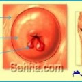 Vaginitis4 لحميات عنق الرحم - هل هذه الاعراض تعني انه يوجد لحمية في الرحم روان فخري