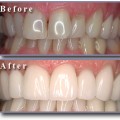 Hwaml-Com 1295975949 793 تجميل الاسنان الاماميه بدون تقويم - كيف تقويم الاسنان تميمة حسام