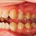 Images G3Rr1 اسباب التهاب اللثة - امراض تؤدي الى فقدان الاسنان سحر فتحي