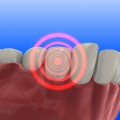 الم الاسنان علاج الم الضرس المسوس - تجنب الاسباب الشائعة لتسوس الضرس سحر فتحي