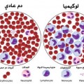 سرطان الدم 2 معلومات اول مرة تعرفها عن اعراض السرطان- عوارض سرطان الدم تميمة حسام