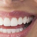 طرق تبييض الأسنان بسرعة امراض اللثة - امراض في الفم سحر فتحي