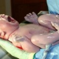 ما هى مخاطر الولادة القيصرية انتفاخ جرح العملية القيصرية - هل يوجد مخاطر من العملية القيصري مشاعر حزينه